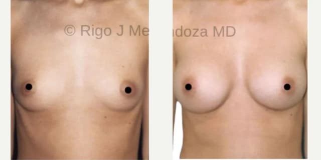 Mommy Makeover procedure image