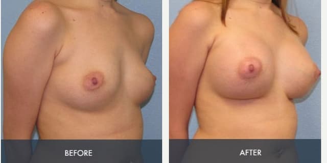 Breast Augmentation procedure image