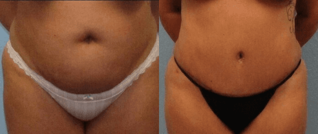 Mommy Makeover procedure image