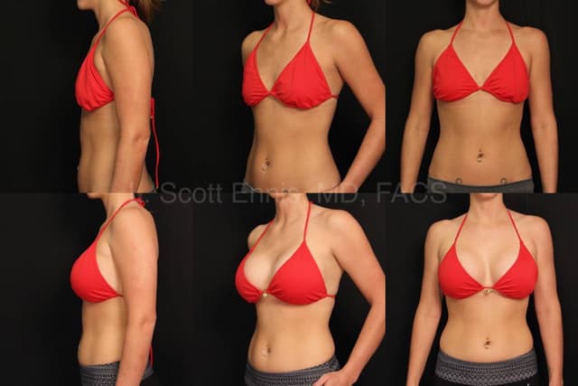 Lipo 360 procedure image