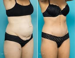 Mommy Makeover procedure image