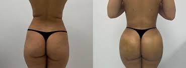 Brazilian Butt Lift (BBL) procedure image