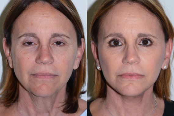 Rhinoplasty (Nose Job) procedure image