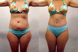 Mommy Makeover procedure image