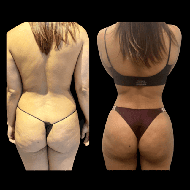 Brazilian Butt Lift (BBL) procedure image