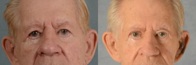 Eyelid Surgery (Blepharoplasty) procedure image