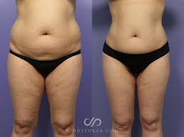 Tummy Tuck (Abdominoplasty) procedure image