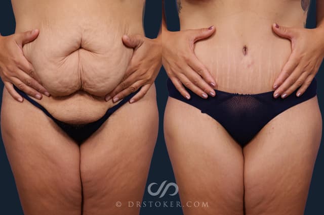 Tummy Tuck (Abdominoplasty) procedure image