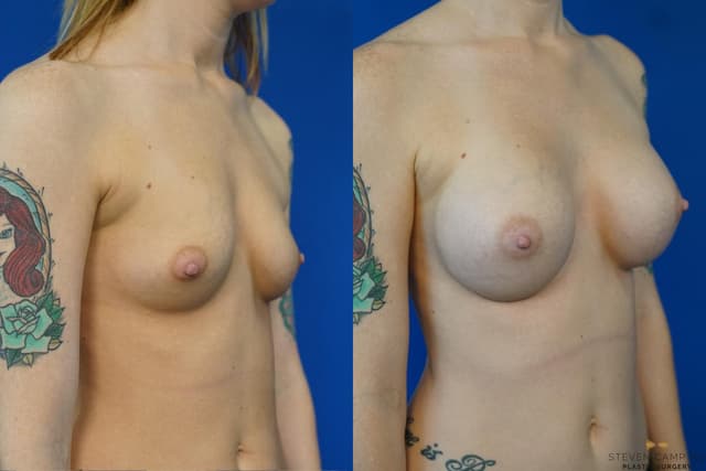 Breast Augmentation procedure image