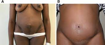 Mommy Makeover procedure image