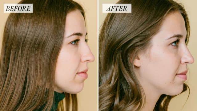 Rhinoplasty (Nose Job) procedure image