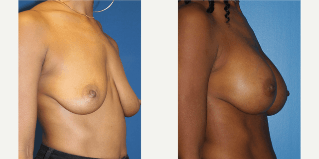 Body Lift procedure image