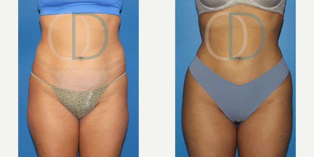 Tummy Tuck (Abdominoplasty) procedure image