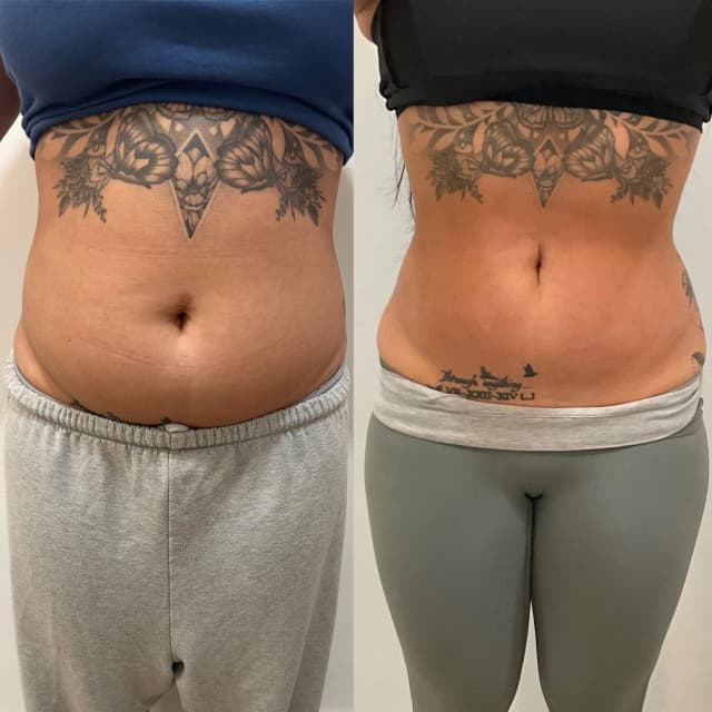 Mommy Makeover procedure image