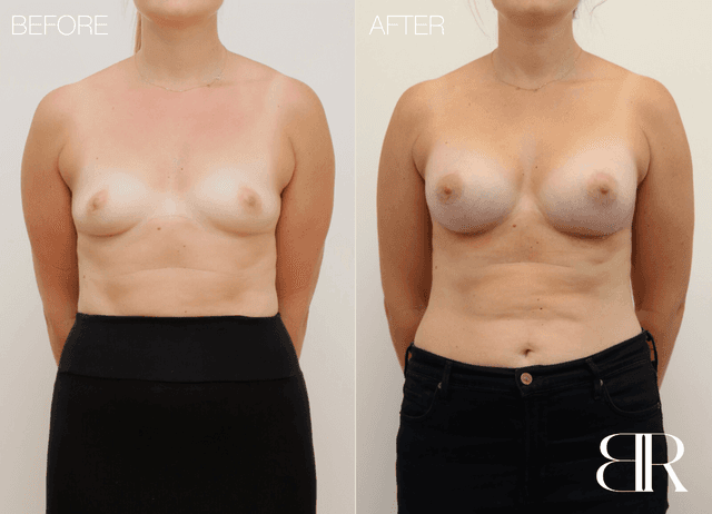 Breast Augmentation procedure image