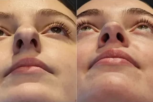 Rhinoplasty (Nose Job) procedure image