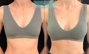 Mommy Makeover procedure image