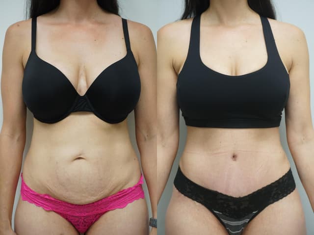 Liposuction procedure image