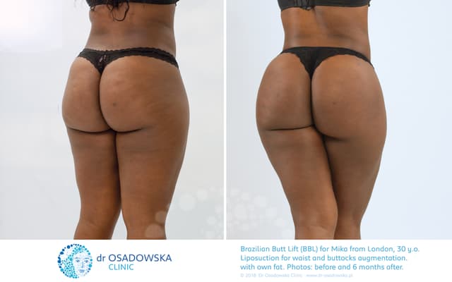 Brazilian Butt Lift (BBL) procedure image