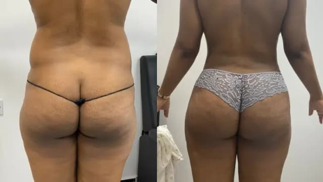 Brazilian Butt Lift (BBL) procedure image
