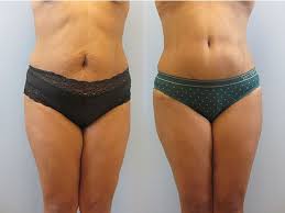Tummy Tuck (Abdominoplasty) procedure image
