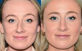 Rhinoplasty (Nose Job) procedure image