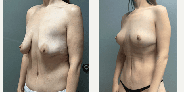 Breast Augmentation procedure image