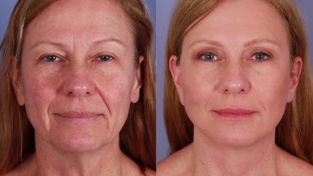 Facelift procedure image