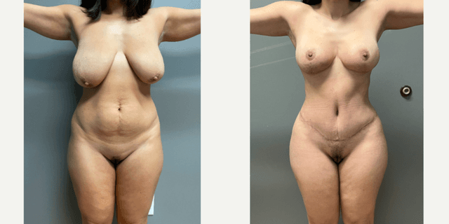 Mommy Makeover procedure image