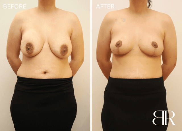 Lipo 360 procedure image