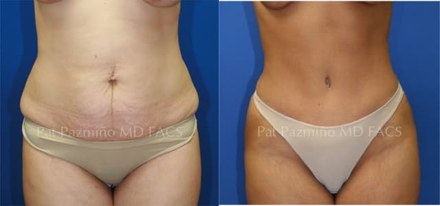 Tummy Tuck (Abdominoplasty) procedure image