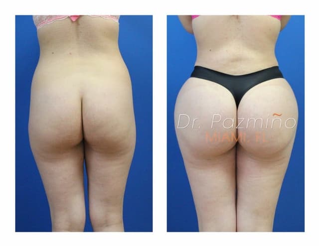 Brazilian Butt Lift (BBL) procedure image