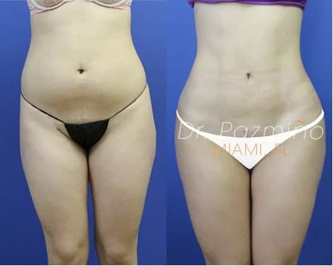 Liposuction procedure image