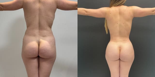 Brazilian Butt Lift (BBL) procedure image