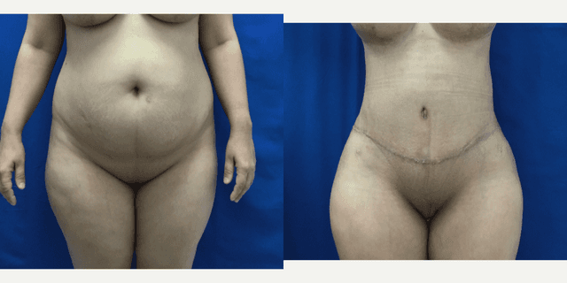 Tummy Tuck (Abdominoplasty) procedure image