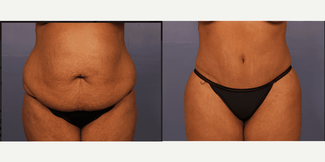 Tummy Tuck (Abdominoplasty) procedure image