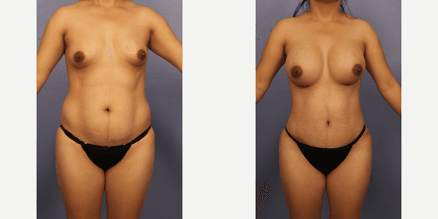 Mommy Makeover procedure image