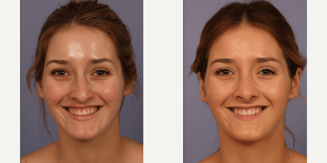 Rhinoplasty (Nose Job) procedure image
