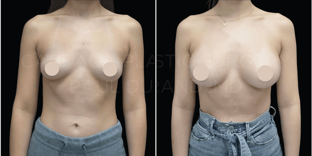 Breast Augmentation procedure image