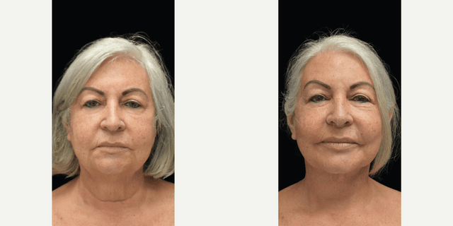 Facelift procedure image