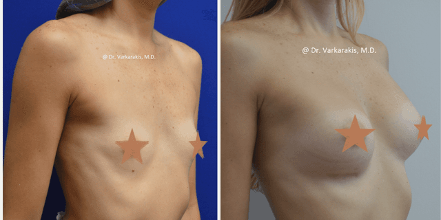 Breast Augmentation procedure image