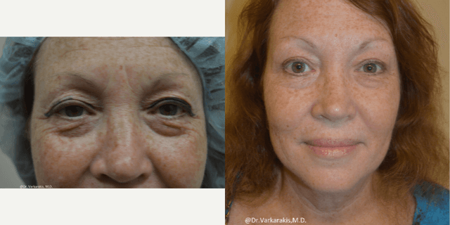 Eyelid Surgery (Blepharoplasty) procedure image