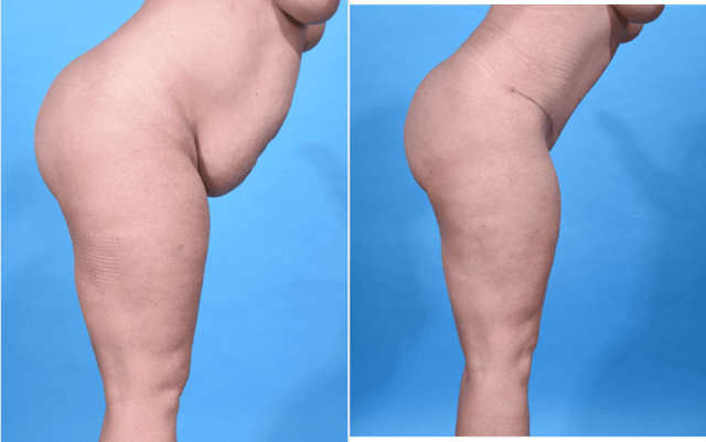 Tummy Tuck (Abdominoplasty) procedure image