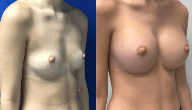 Breast Augmentation procedure image
