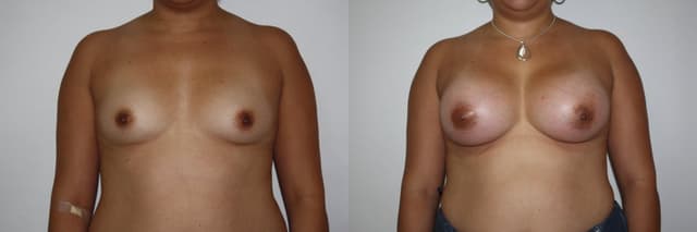 Breast Implants (Saline/Silicone) procedure image