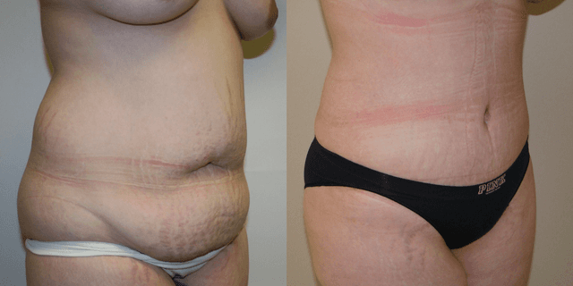 Tummy Tuck (Abdominoplasty) procedure image