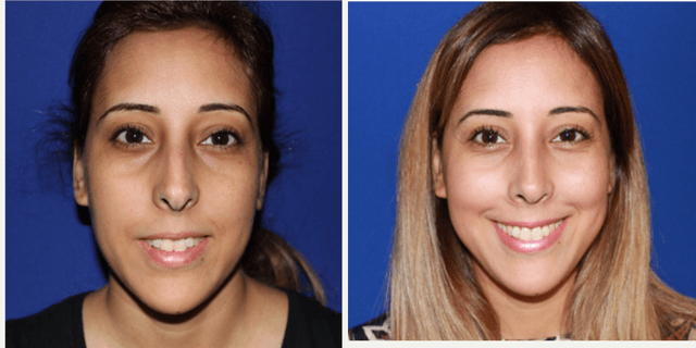 Rhinoplasty (Nose Job) procedure image