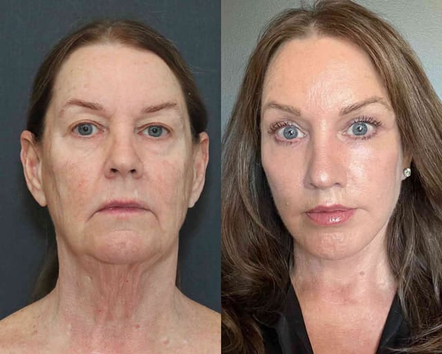 Facelift procedure image