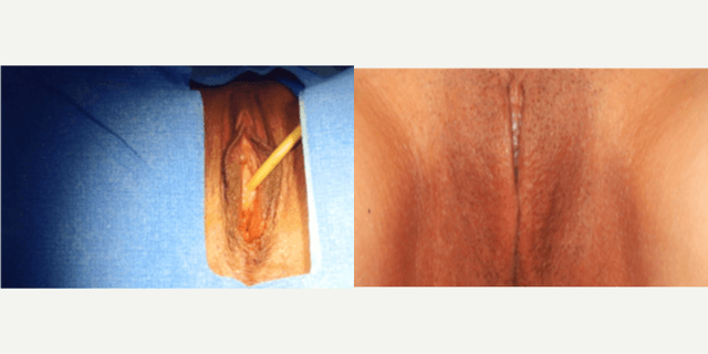 Vaginal Rejuvenation procedure image