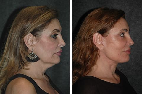 Facelift procedure image